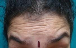 botox treatment in bangalore -before treatment