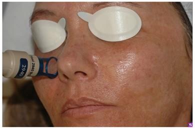 Laser Treatment for Melasma