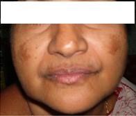 Moderate Case of Melasma