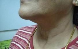 botox treatment in bangalore -after treatment