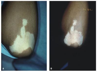 targeted phototherapy for vitiligo
