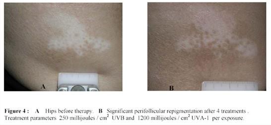 Targeted Phototherapy 39