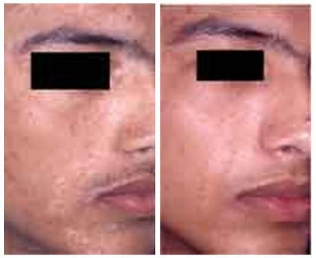 Targeted Phototherapy 4