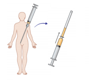 Fat Grafting and Nano Fat at Venkat Center