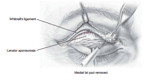 Blepharoplasty at Venkat Center