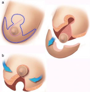 Breast Reduction at Venkat Center