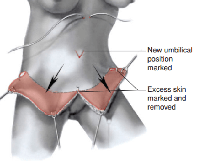 Tummy tuck surgery procedure details