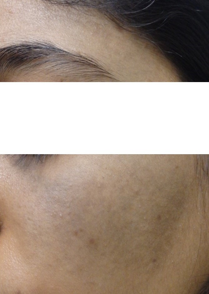 after Nevus of ota Q-switched laser 4 sessions