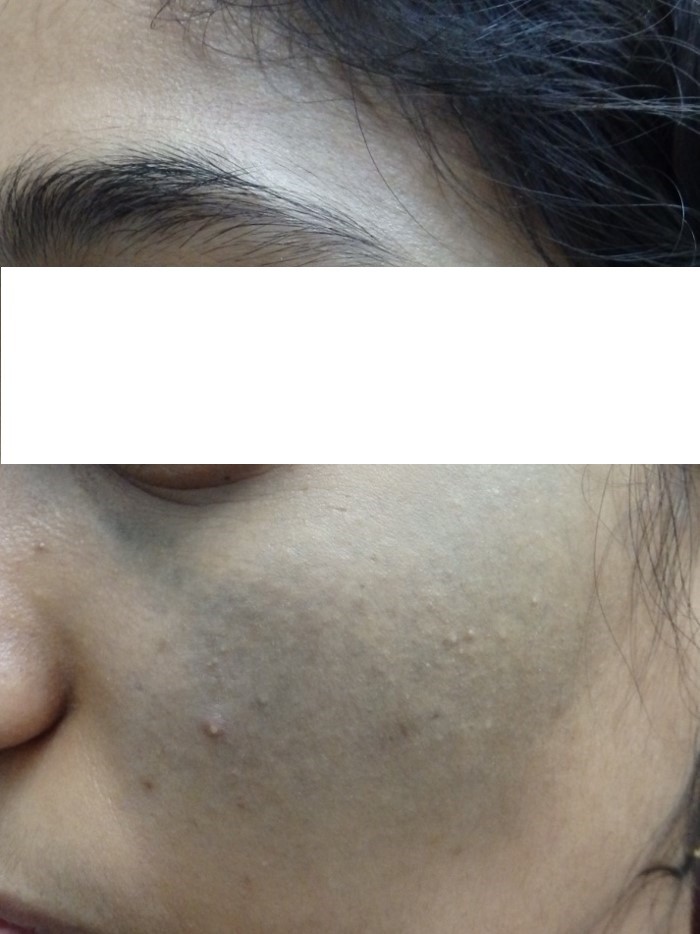before Nevus of ota Q-switched laser 4 sessions