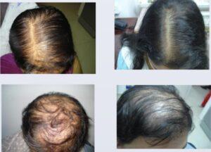 Patietns befroe and after PRP treatment