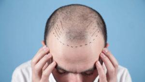 hair transplant in india