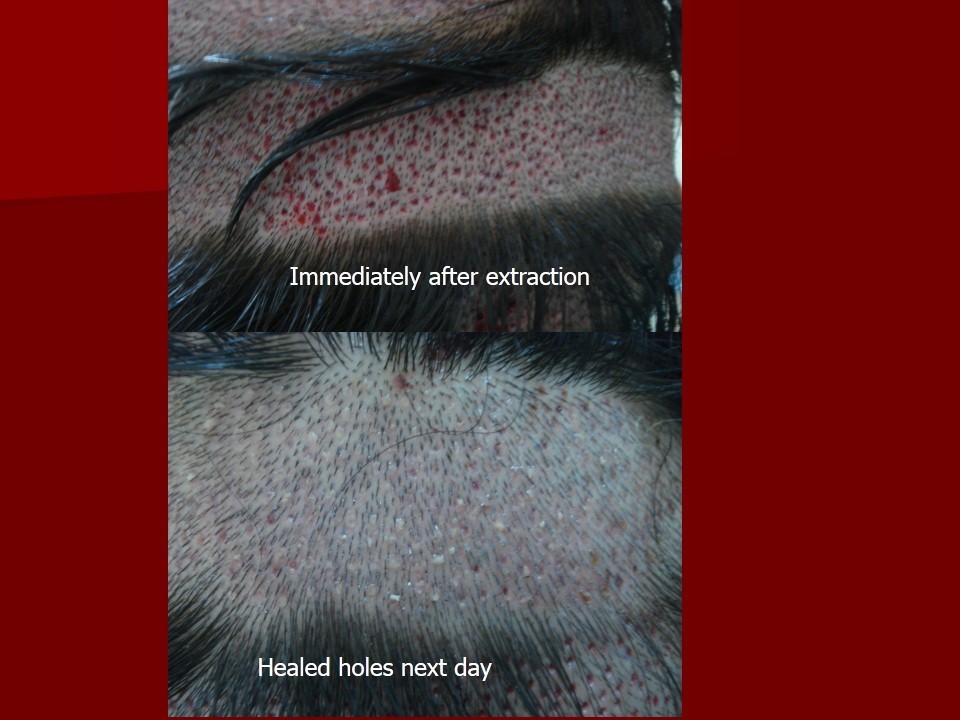 Follicular unit extraction sites post-extraction