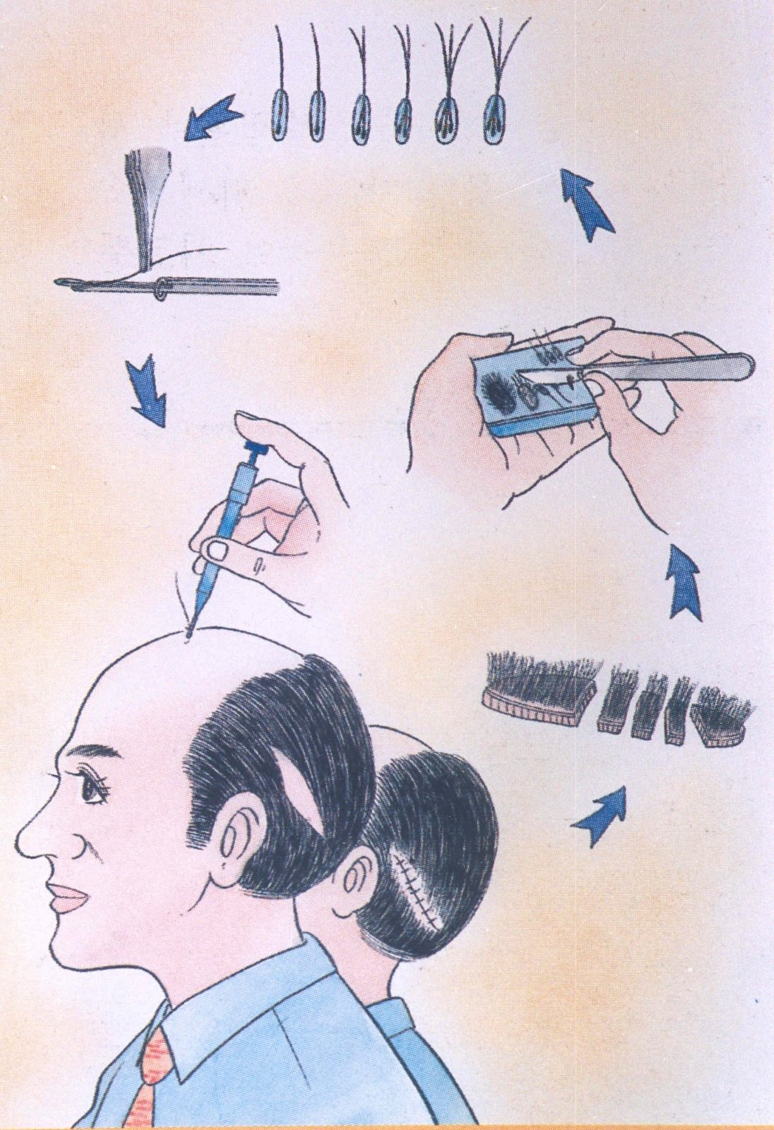 Representative diagram of follicular unit transplantation