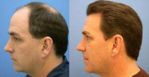 hair transplant guidelines