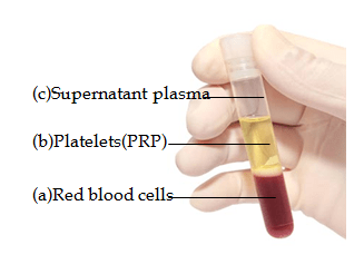 Extractig Platelet rich plasma prp from blood for hair loss treatment