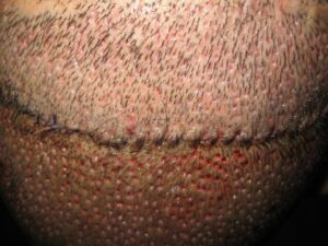 fut and fue both done simultaneously on a patient that requires large number of grafts