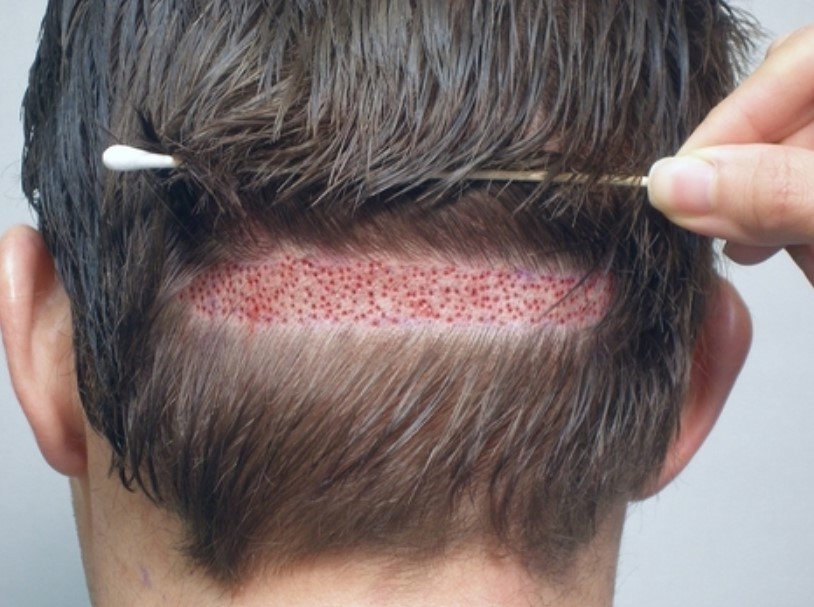 Body Hair Transplantation in Bangalore, India 3 body hair transplantation