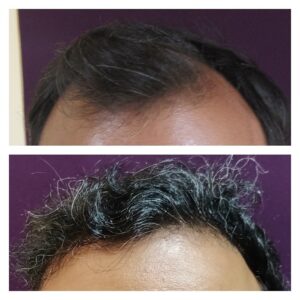 hair transplant results at The Venkat Center