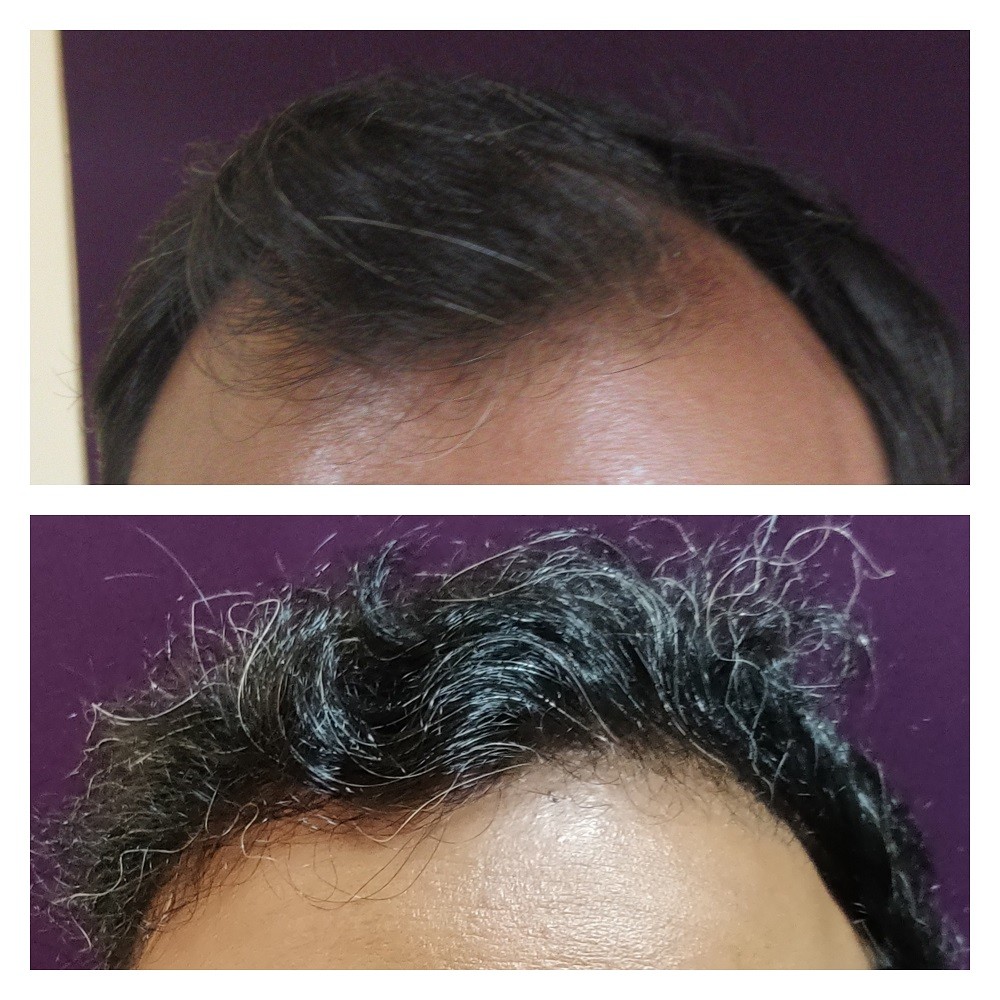 Hair Transplant Results | Before & After Images - The Venkat Center