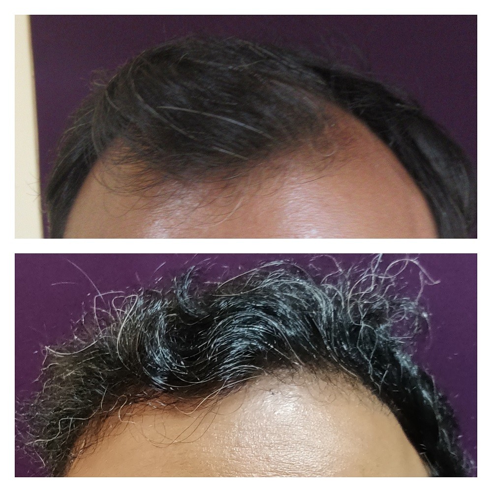 Hair Transplant Results | Before & After Images - The Venkat Center Hair Transplant Results | Before & After Images - The Venkat Center