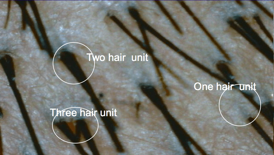 Why do i have two hairs in one follicle