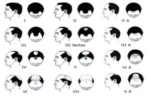 hamilton classification of hair loss in men