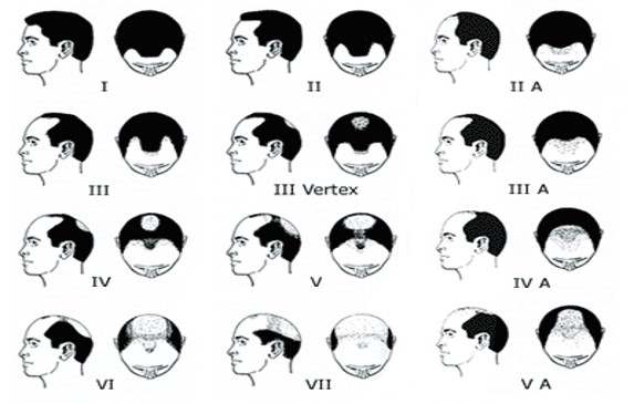 Hereditary Baldness | The Venkat Center For Hair Transplant