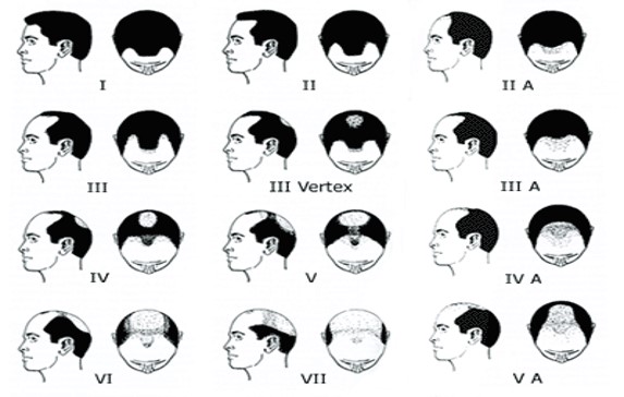 hereditary baldness