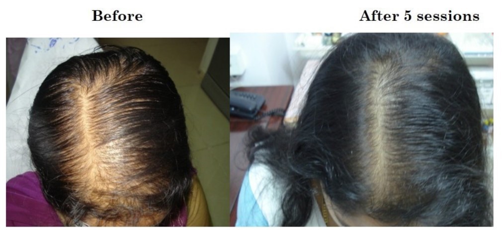 prp results in patients at the venkat center