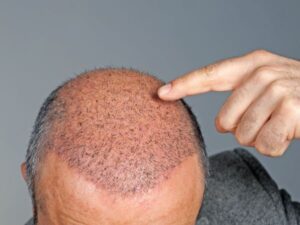What happens after hair transplant?