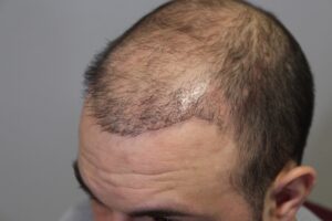 Unethical practices in hair transplantation