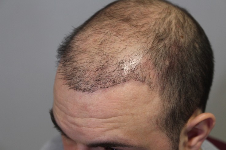 Unethical Practices In Hair Transplantation | Important Precautions To  Consider