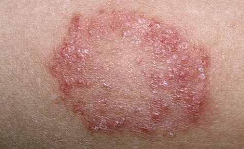 fungal infection of skin