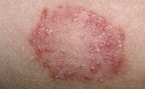 Ringworm - Dermatology Care of Charlotte