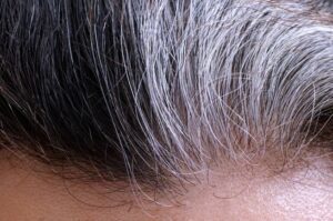 Premature Grey Hair