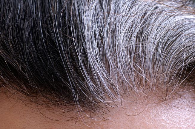 Premature Grey Hair | Effective Treatment At Venkat Center