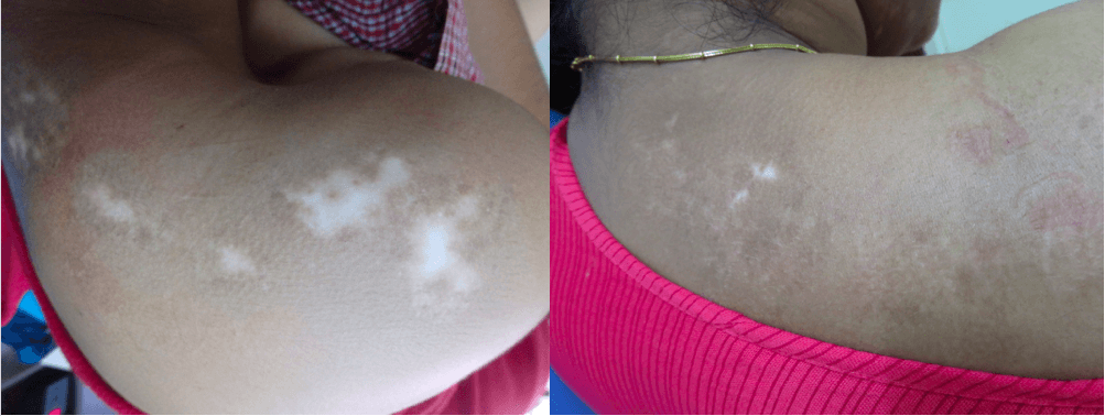 Leucoderma Cause, Sintomi e Trattamento 1