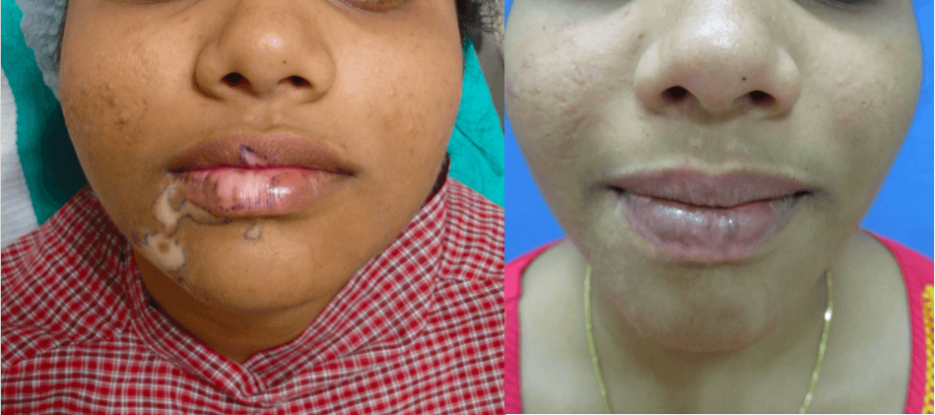 Leucoderma [Vitiligo] Causes, Symptoms and Treatment 1