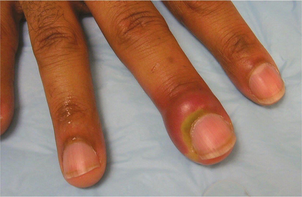 Nail Infection (Paronychia): What It Is, Symptoms, Causes, Treatment