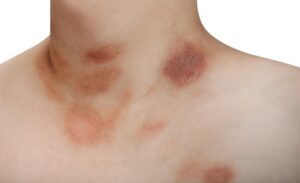 pityriasis rosea