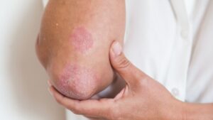 psoriasis treatment in bangalore