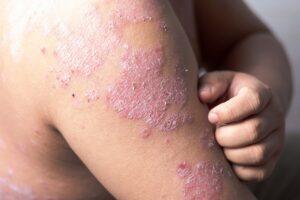 psoriasis treatment in bangalore