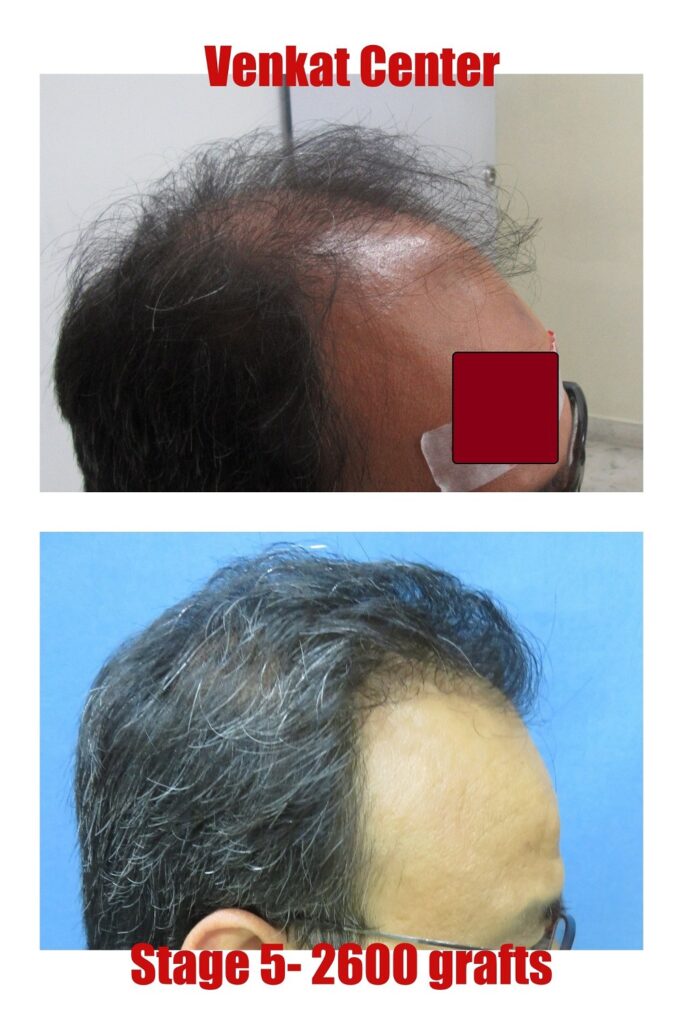 Results of hair transplantation at the venkat center