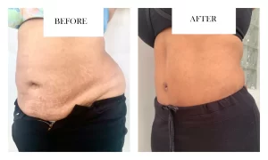 liposuction in abdomen