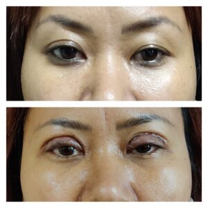 Asian Blepharoplasty treatment at the venkat centereatment at the venkat center