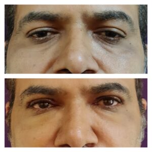 Blepharoplasty treatment at the venkat center