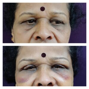 Blepharoplasty treatment at the venkat center