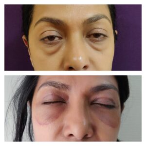 Blepharoplasty treatment at the venkat center