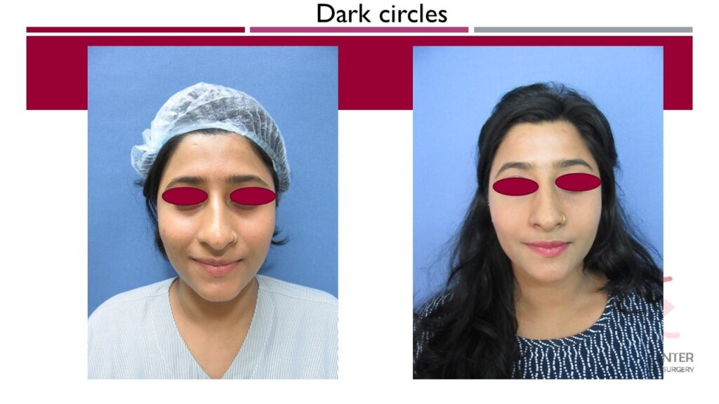 Fat grafting for dark circles