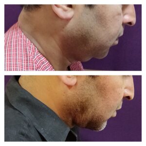 Double Chin Treatment at The Venkat Center